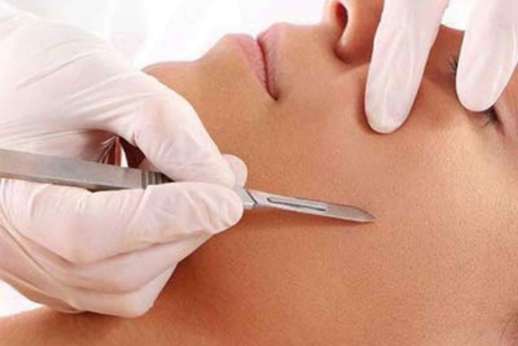 Dermaplaning