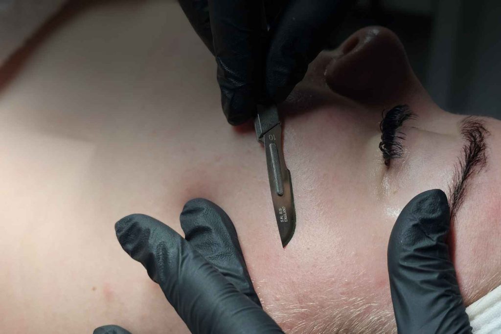 Dermaplaning